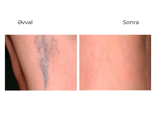 Candela GentleMax Pro